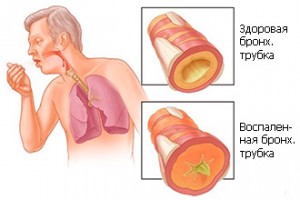 bronhialniye-trubki