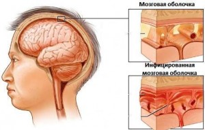 meningit-shema-vospalenia